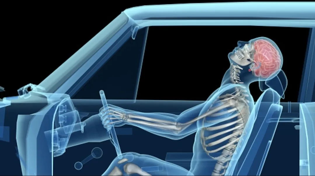 The Truth About Whiplash: Why It’s More Than Just A “Stiff Neck”