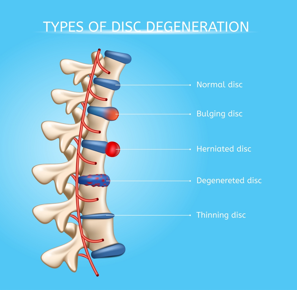 Spinal Disc Injuries Treatment Bountiful Utah