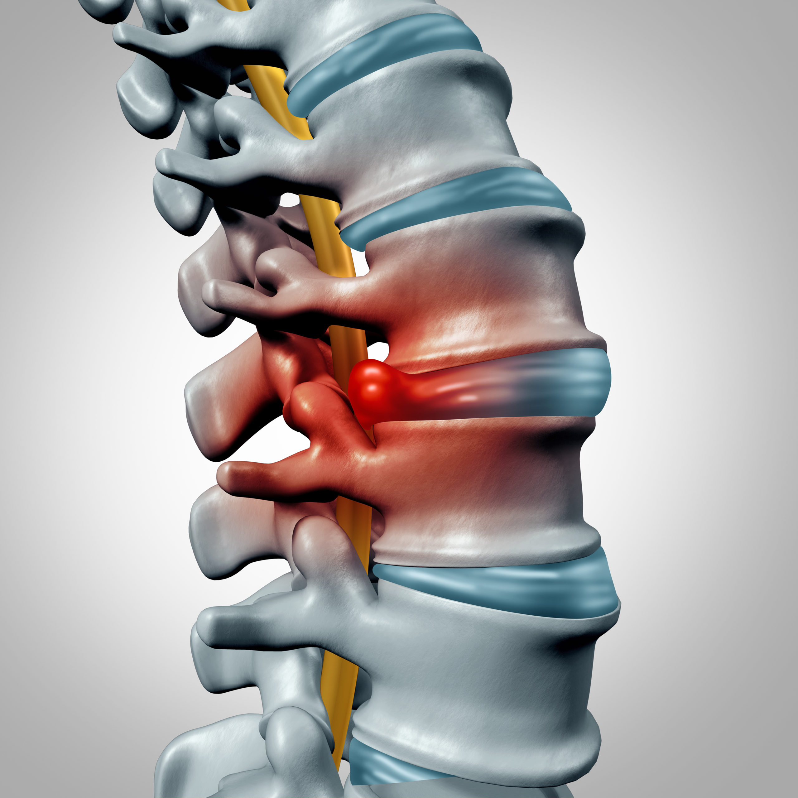 Bountiful UT Herniated Disc Treatment