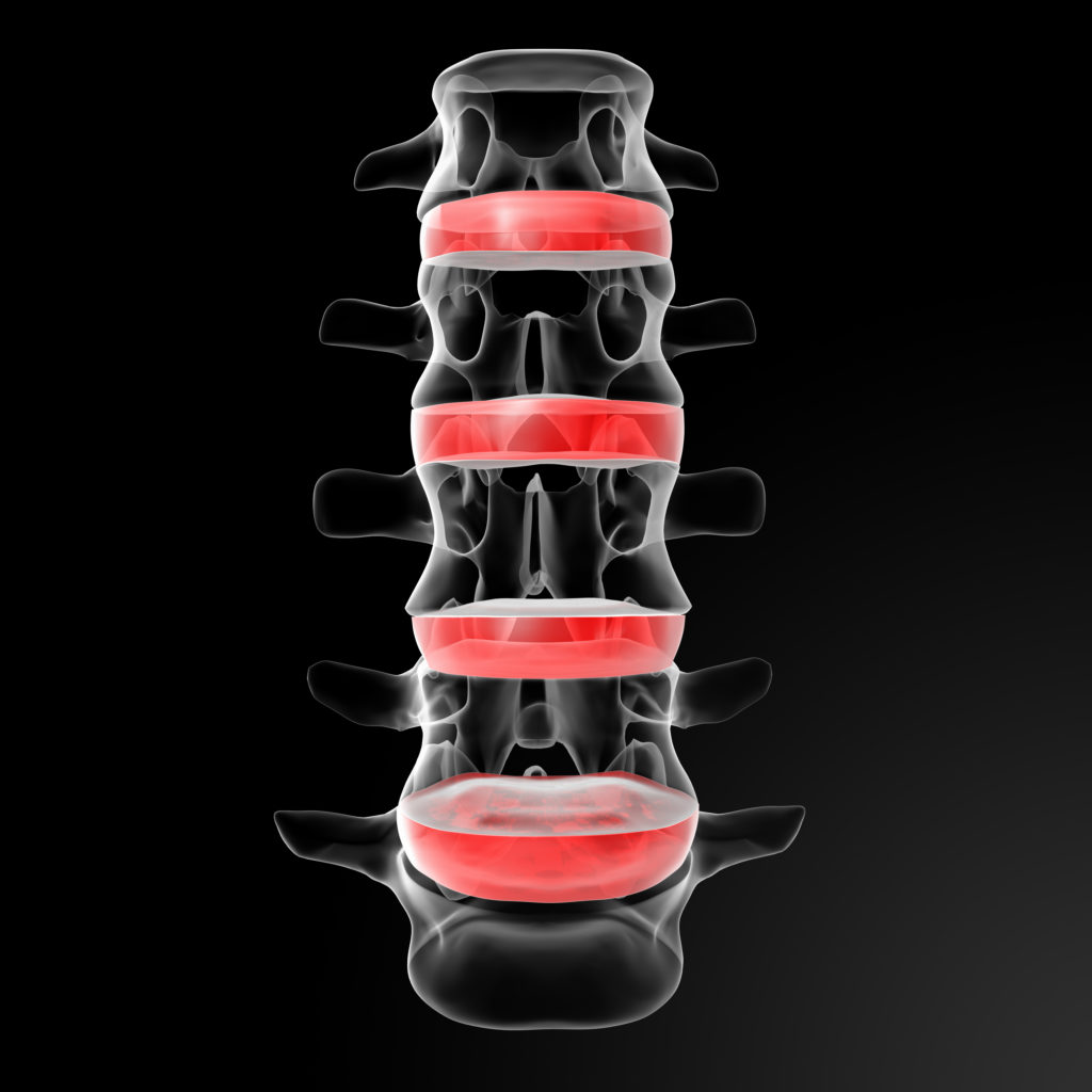 What Are Herniated Discs? What are Herniated Discs?