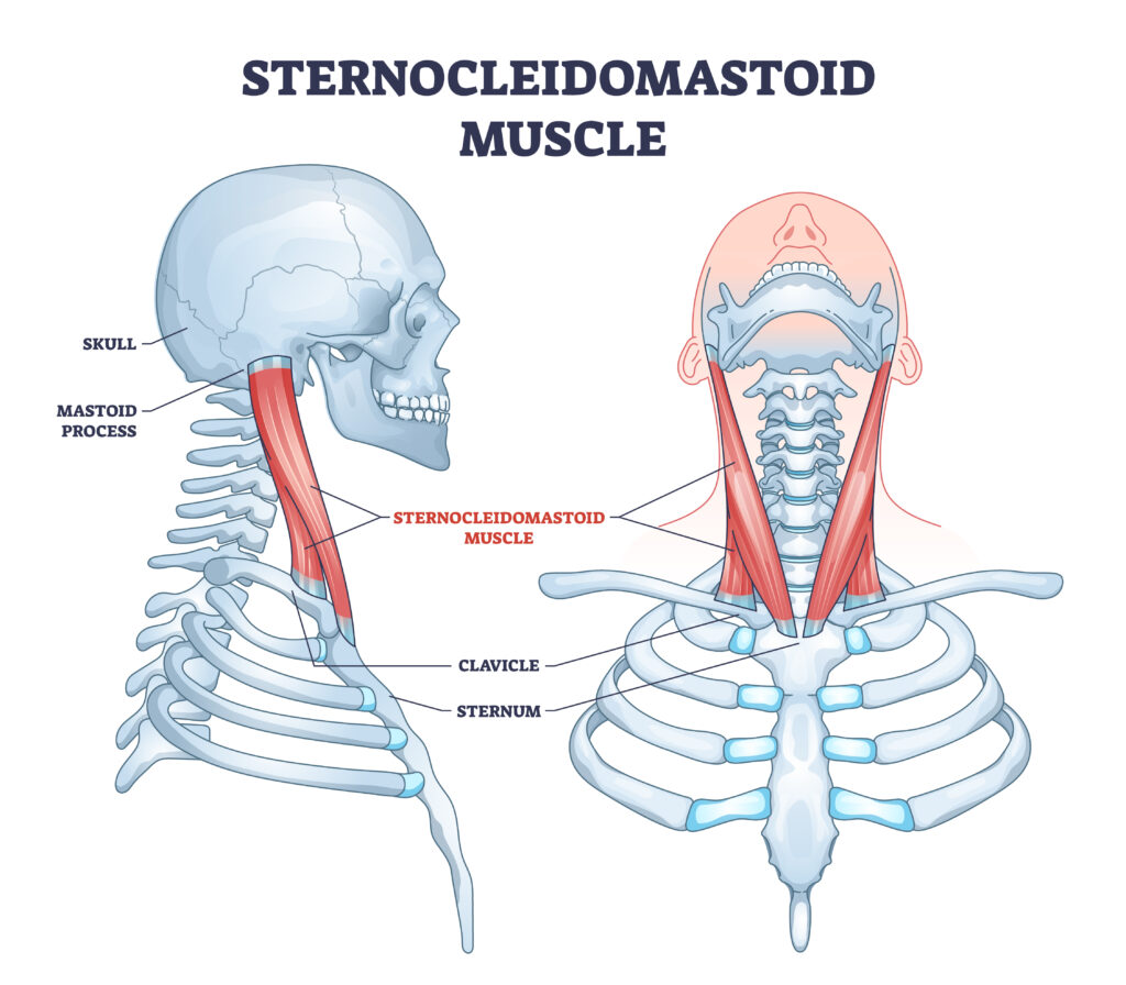 Torticollis: Causes, Symptoms, and the Role of Chiropractic Care